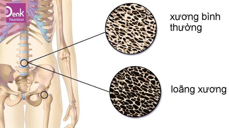 Giảm nguy cơ loãng xương khi mang thai