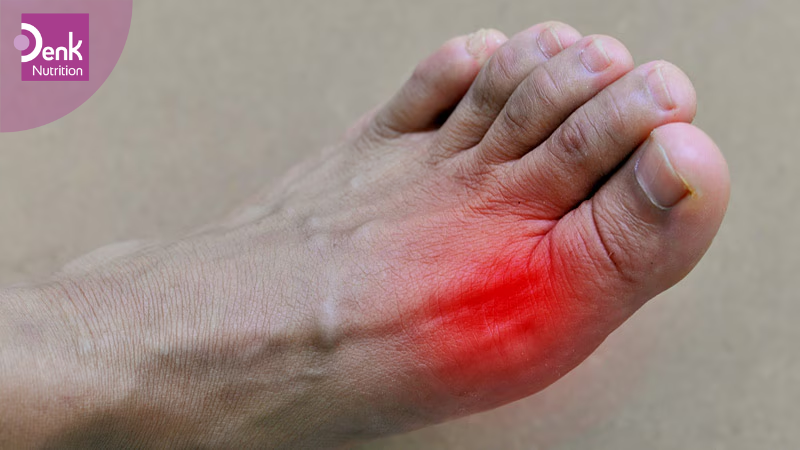 Ngăn ngừa các cơn gút