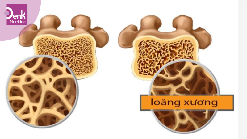 Điều trị loãng xương