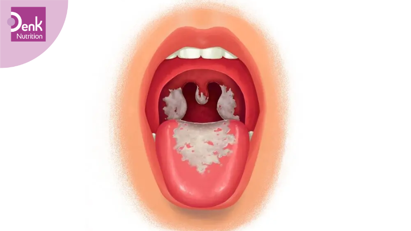 Các loại bệnh bạch hầu