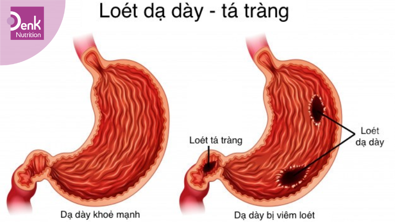 Hỗ trợ điều trị loét dạ dày tá tràng