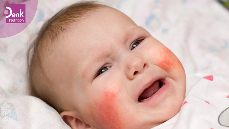 Dị ứng sữa công thức là gì?