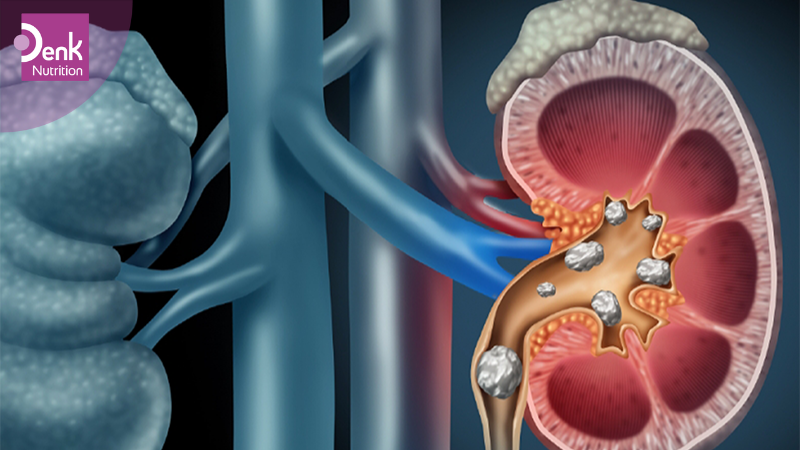 Giảm nguy cơ mắc sỏi thận