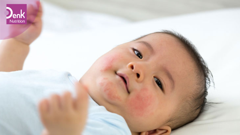 Trẻ bị dị ứng sữa - Nguyên nhân và cách xử lý hiệu quả