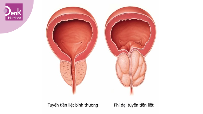 Tăng cường sức khỏe tuyến tiền liệt