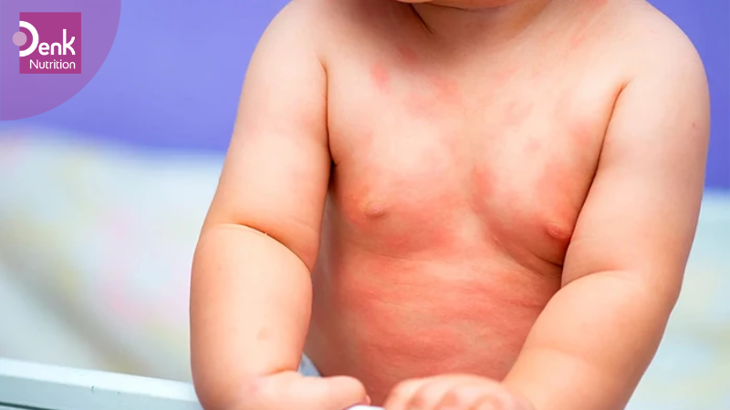 Cách xử lý khi trẻ bị dị ứng sữa