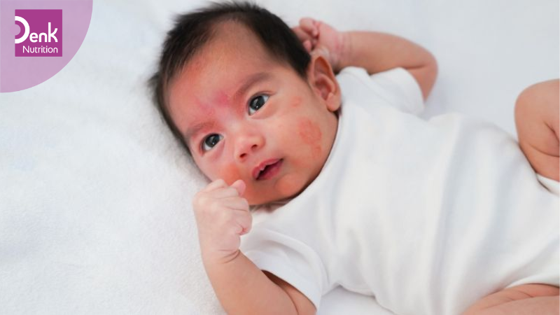 Dấu hiệu bé bị dị ứng sữa mẹ