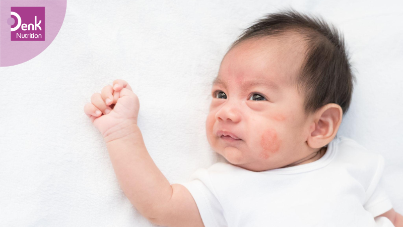 làm sao để biết bé dị ứng sữa bò?