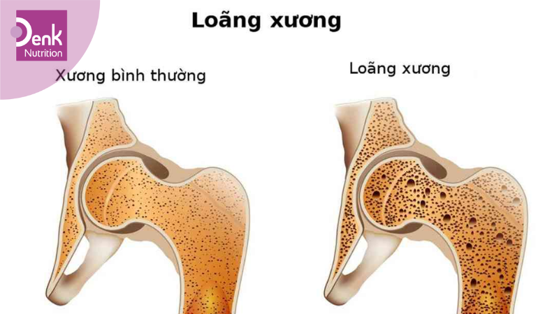 Giảm nguy cơ loãng xương