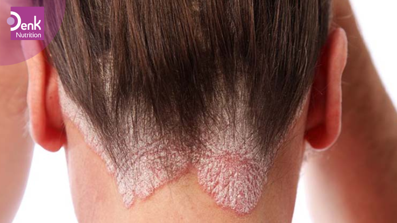 Hỗ trợ cải thiện các bệnh lý ngoài da