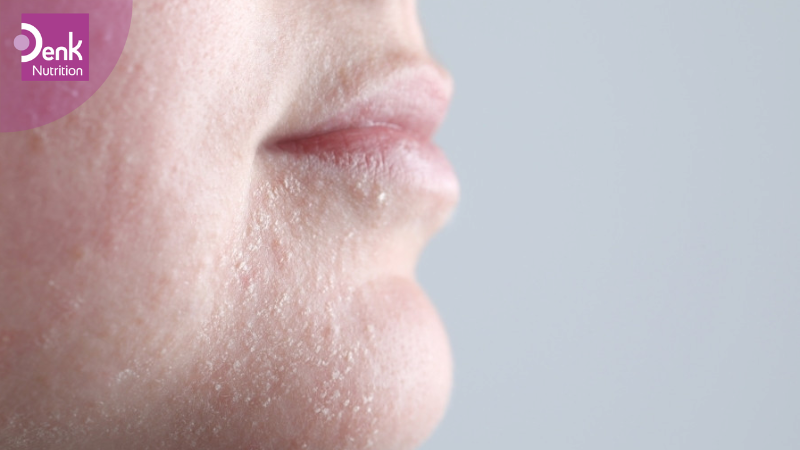 Da khô ráp,sần sùi