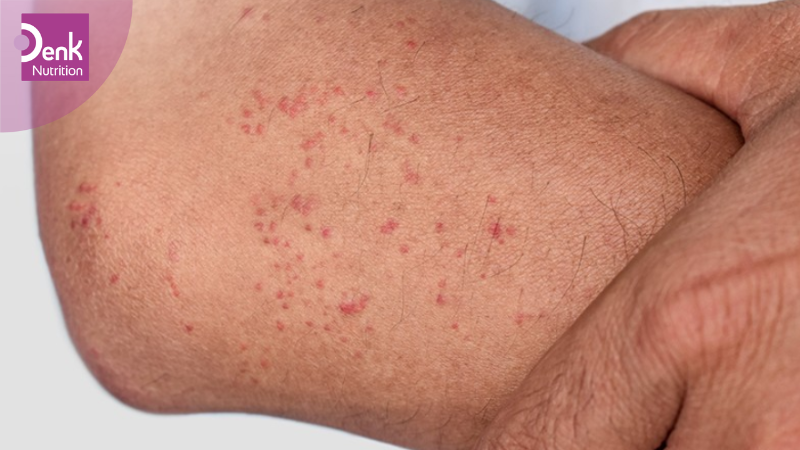 Mẫn đỏ tươi xung quanh nang lông