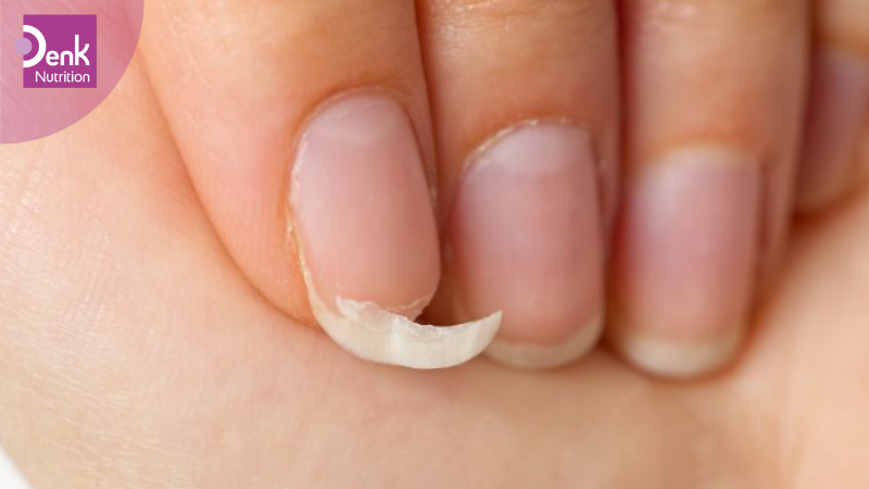 Móng tay dễ bị gãy