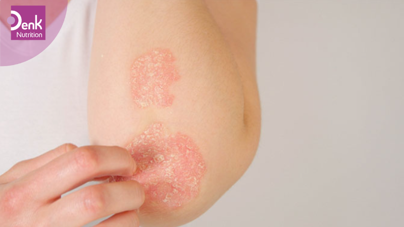 Điều trị bệnh chàm