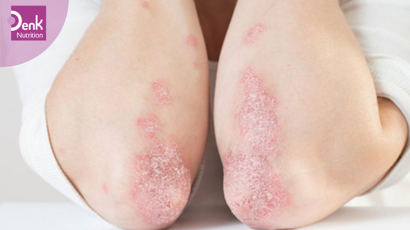 Điều trị bệnh vẩy nến