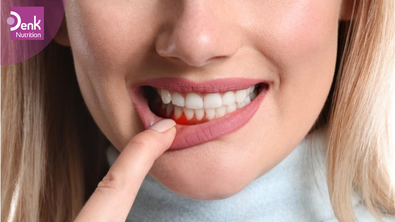 Chảy máu ở nướu răng, chân răng, rụng răng