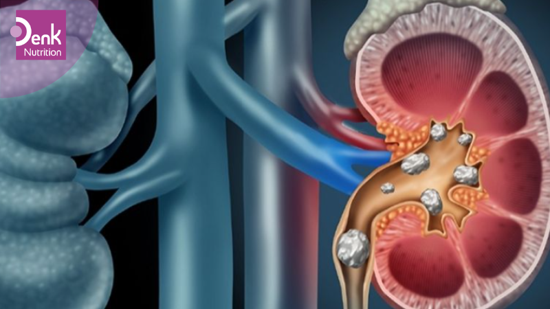 Ngăn ngừa sỏi thận