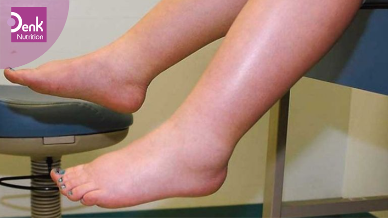 Giảm tình trạng giữ nước