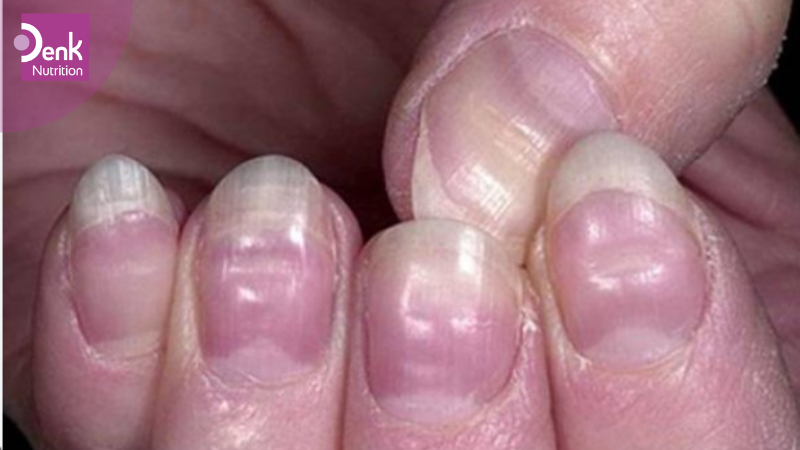 móng tay lõm hình thìa có đốm hoặc đường màu đỏ