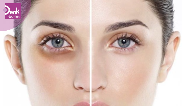 Giải quyết các vấn đề quanh vùng mắt, giảm quần thâm mắt