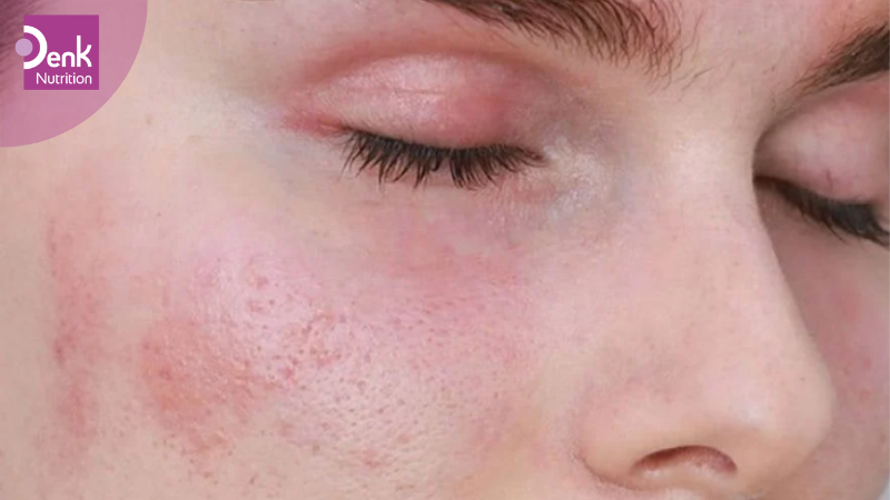 Giảm mẩn đỏ trên da