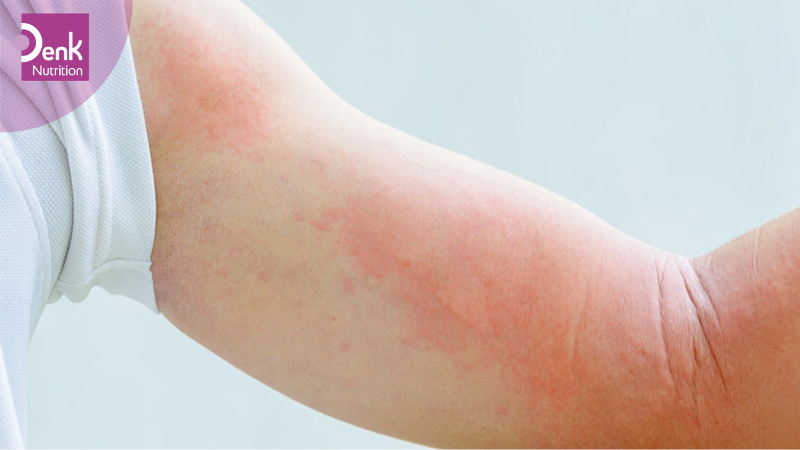 Điều trị viêm khớp và các triệu chứng dị ứng