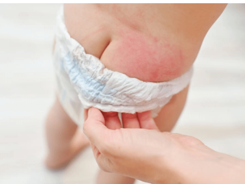 2.1 Bé bị hăm tã – Một trong những nỗi lo phổ biến nhất