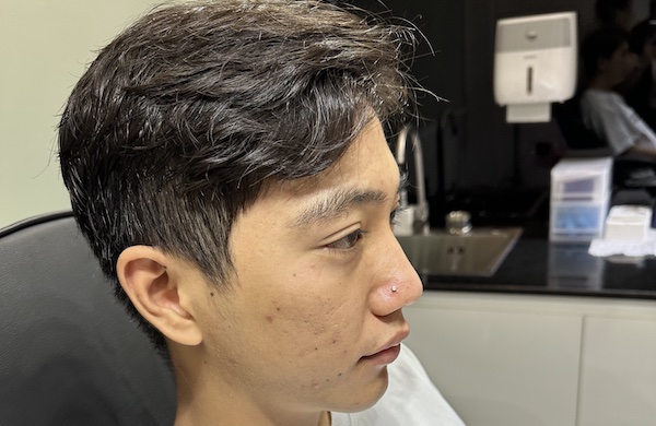 Bấm lỗ mũi bao nhiêu tiền