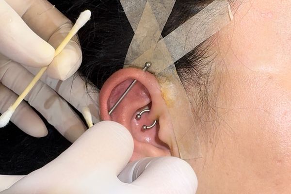 Bấm lỗ tai 1 tuần bị sưng và cách sơ cứu tại nhà an toàn