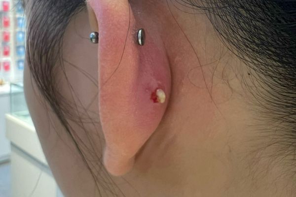 Bấm lỗ tai bị áp xe