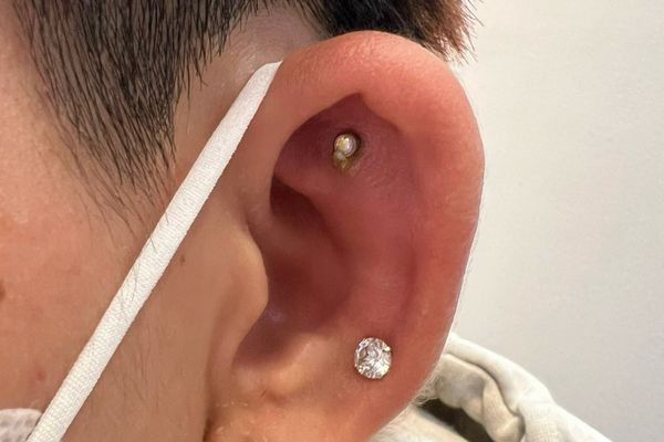 Bấm lỗ tai bị áp xe