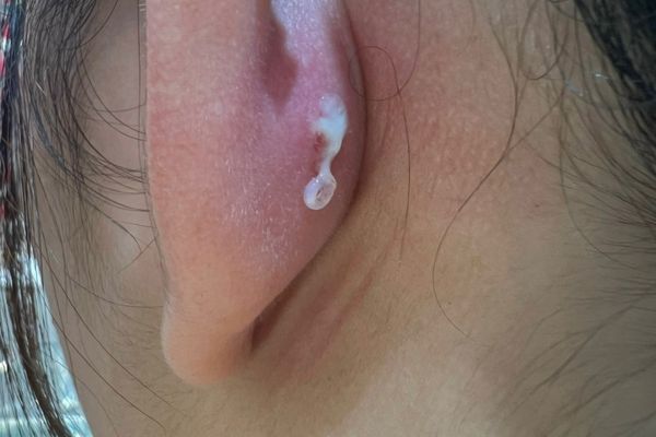 Bấm lỗ tai bị áp xe