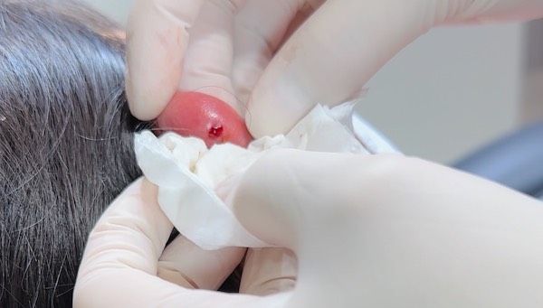 Bấm lỗ tai bị sưng đỏ phải làm sao