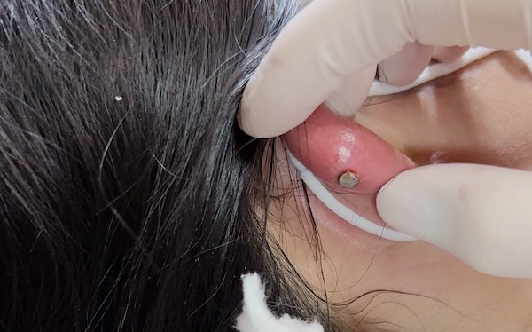 Bấm lỗ tai bị sưng đỏ phải làm sao