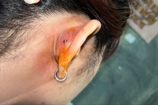 lỗ xỏ / lỗ bấm bị sưng đỏ do nhiễm trùng