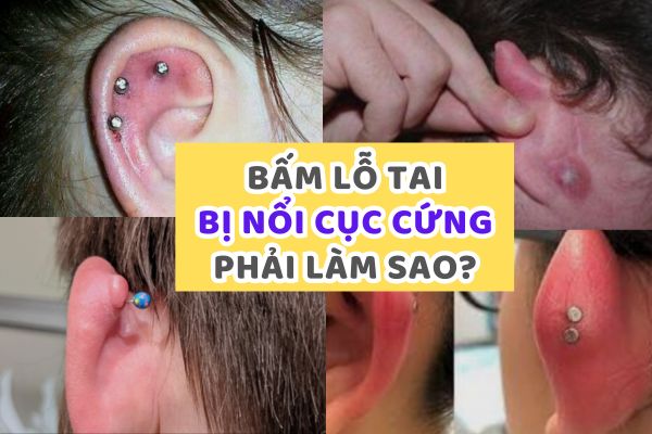 Bấm lỗ tai bị nổi cục cứng phải làm sao?