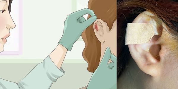 Bấm lỗ tai trên sụn và những rủi ro tiềm ẩn