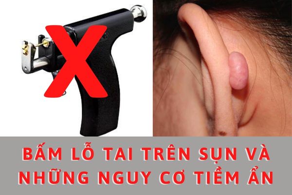 Bấm lỗ tai trên sụn và những rủi ro tiềm ẩn