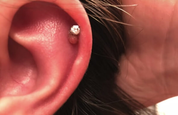 Bị bump có nên tháo khuyên không