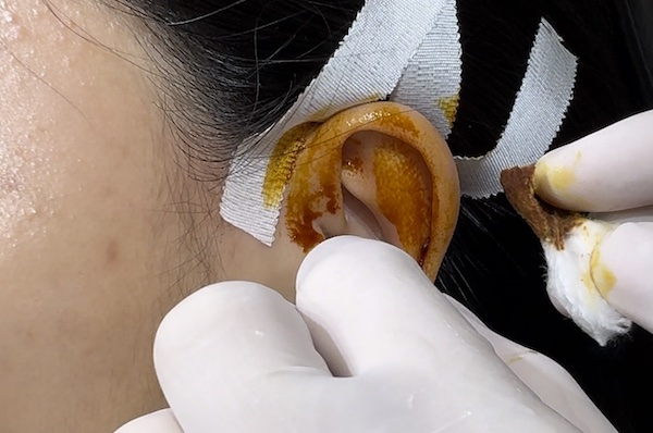 Bị bump có nên tháo khuyên không