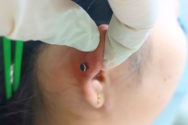 Bị bump lỗ xỏ nên ghé shop xỏ khuyên hay bệnh viện?