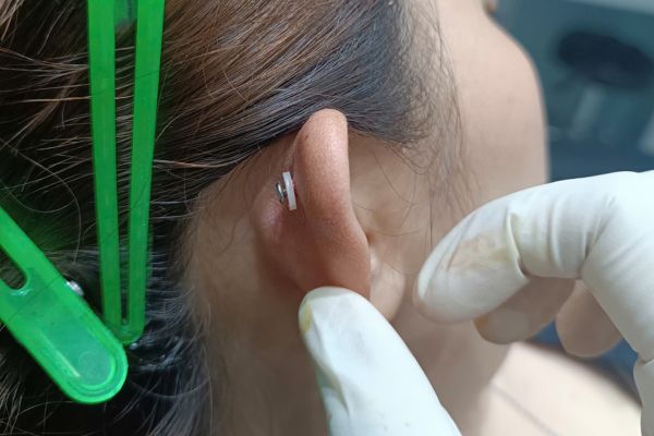 Bị bump lỗ xỏ nên ghé shop xỏ khuyên hay bệnh viện?