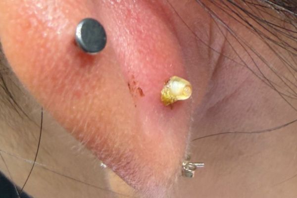 lỗ xỏ tiết mủ, sưng tấy lan rộng, không phải bump thông thường