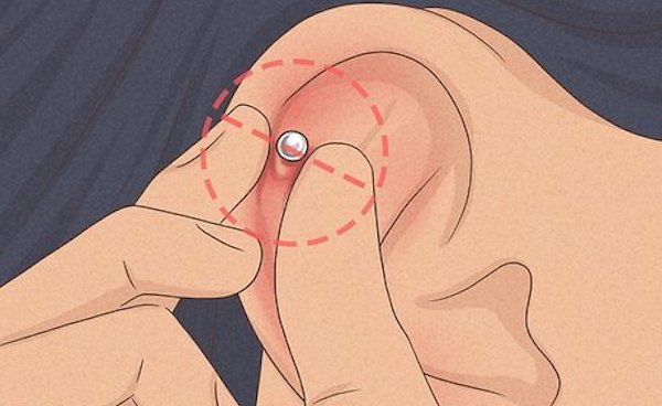 Bị bump lỗ xỏ phải làm sao
