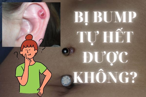 Bị bump tự hết được không
