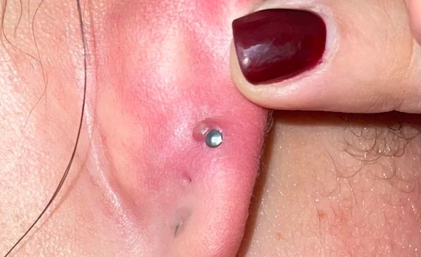 Bị bump tự hết được không