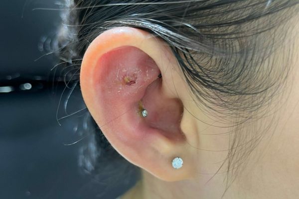 Các dấu hiệu bị dị ứng sau khi xỏ khuyên