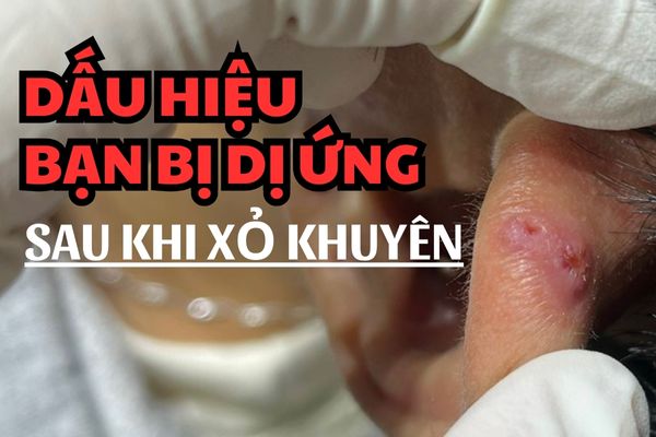 Các dấu hiệu bị dị ứng sau khi xỏ khuyên