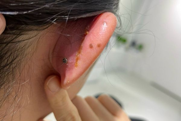 Các dấu hiệu bị dị ứng sau khi xỏ khuyên