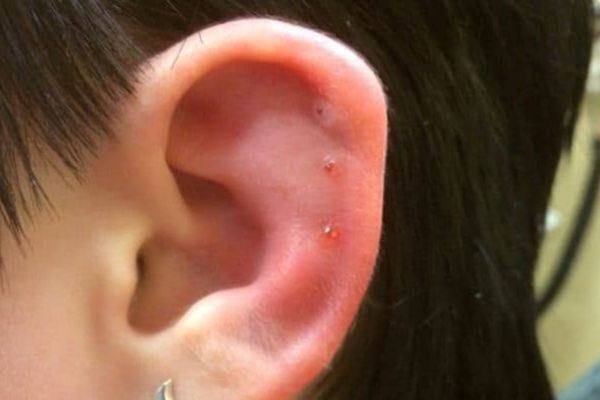 Các dấu hiệu bị dị ứng sau khi xỏ khuyên